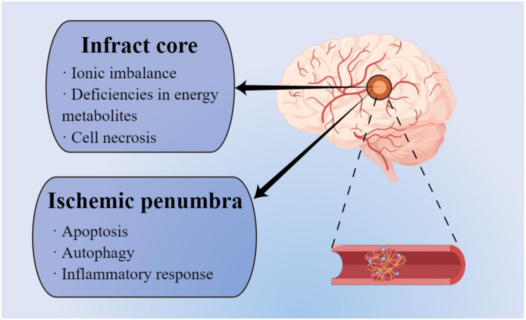 Perspective insights into hydrogels and nanomaterials for ischemic stroke